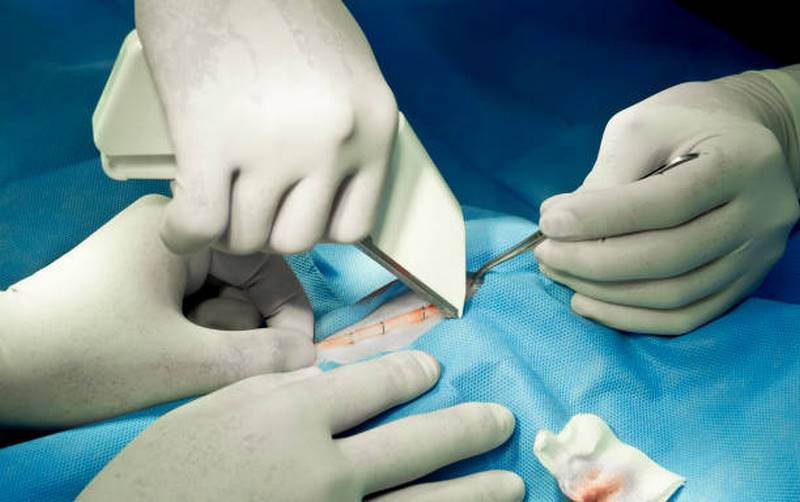 کاربرد استپلر جراحی در عمل جراحی 